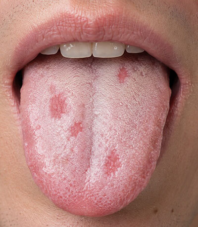 Example of oral lichen planus lesions on the tongue